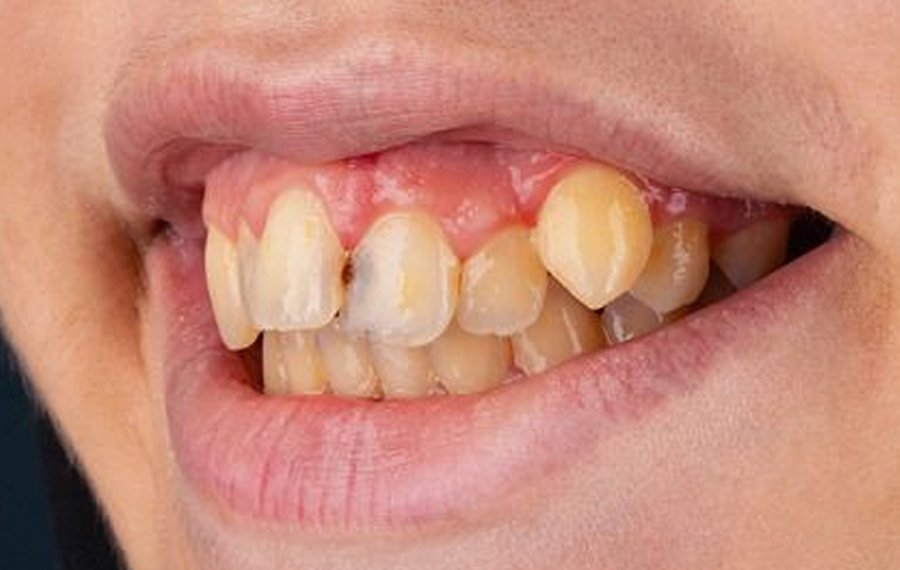 Teeth Polishing Scaling Dubai