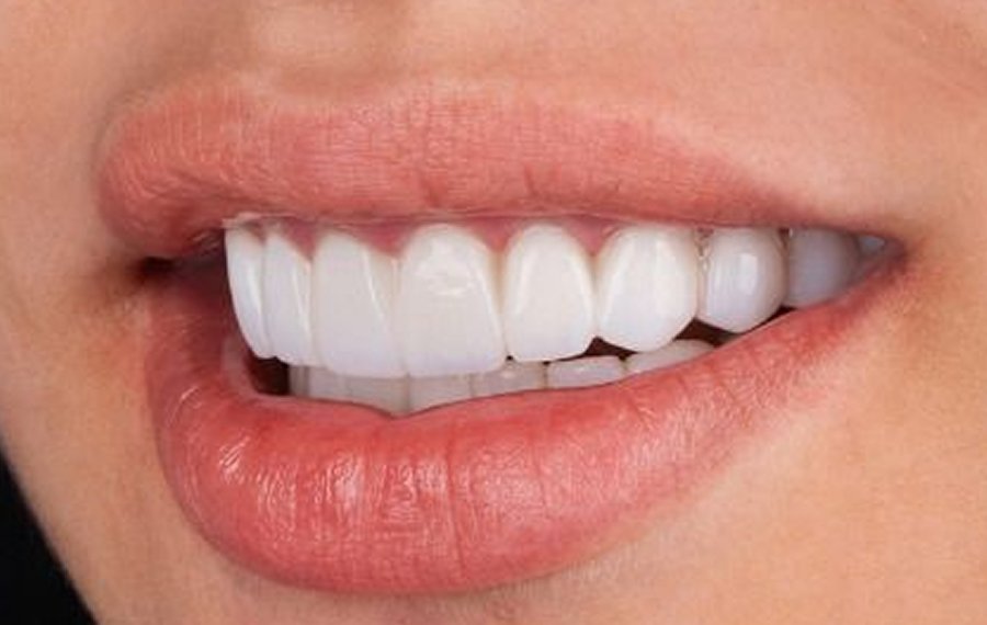 Teeth Polishing Scaling in Dubai