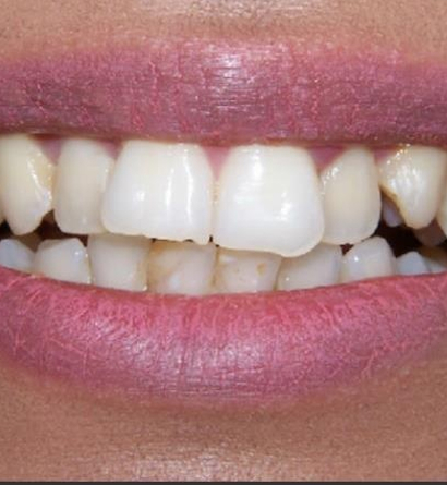 Teeth Retainers Dubai