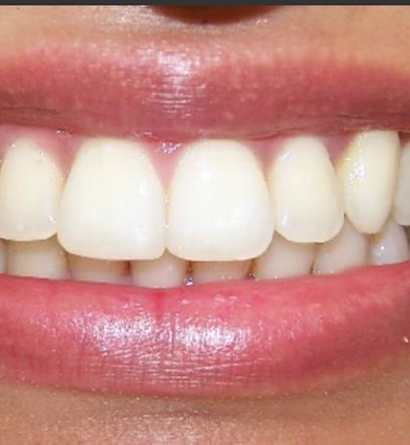 Teeth Retainers in Dubai