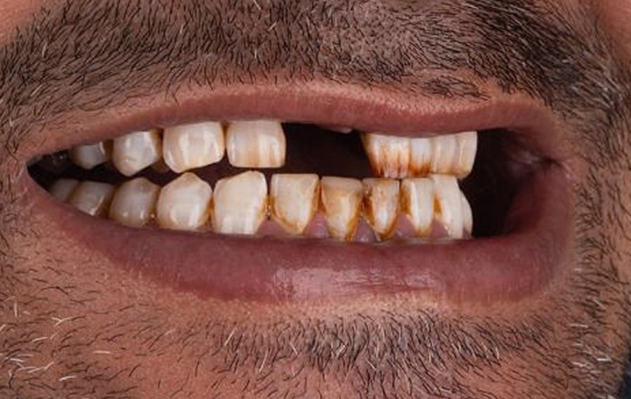 Tooth Extraction Dubai