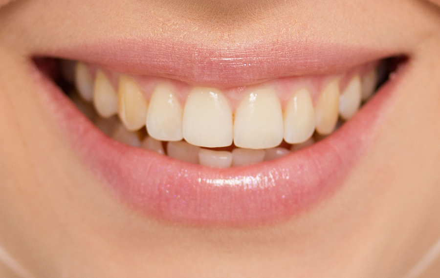 Tooth Removal in Dubai Tooth Removal in Dubai