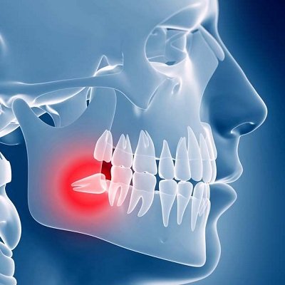 Wisdom Tooth Extraction in Dubai - Dental Clinic Dubai