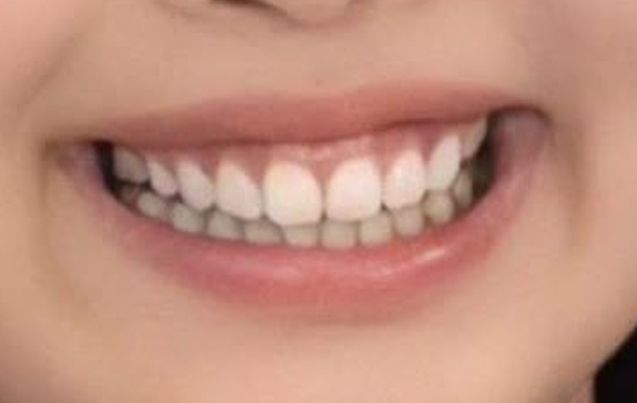 Zirconia Crown Dubai