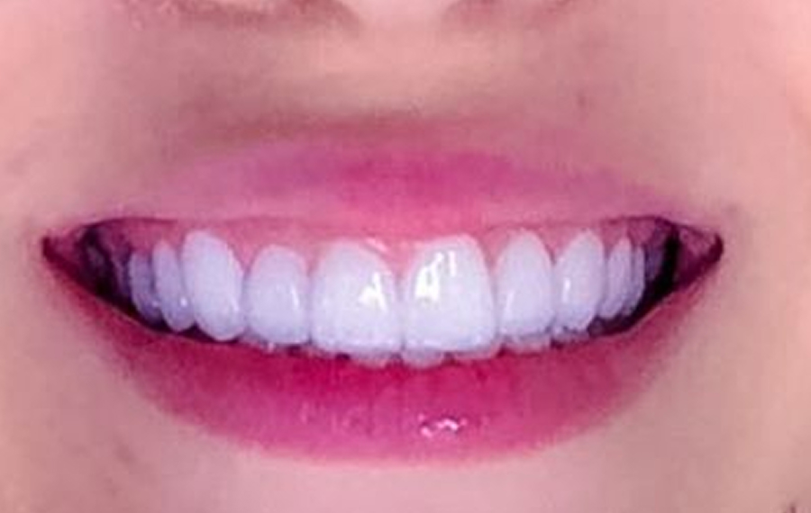 Zirconia Crown in Dubai