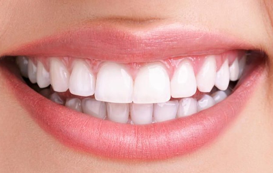 Zoom Teeth Whitening Dubai