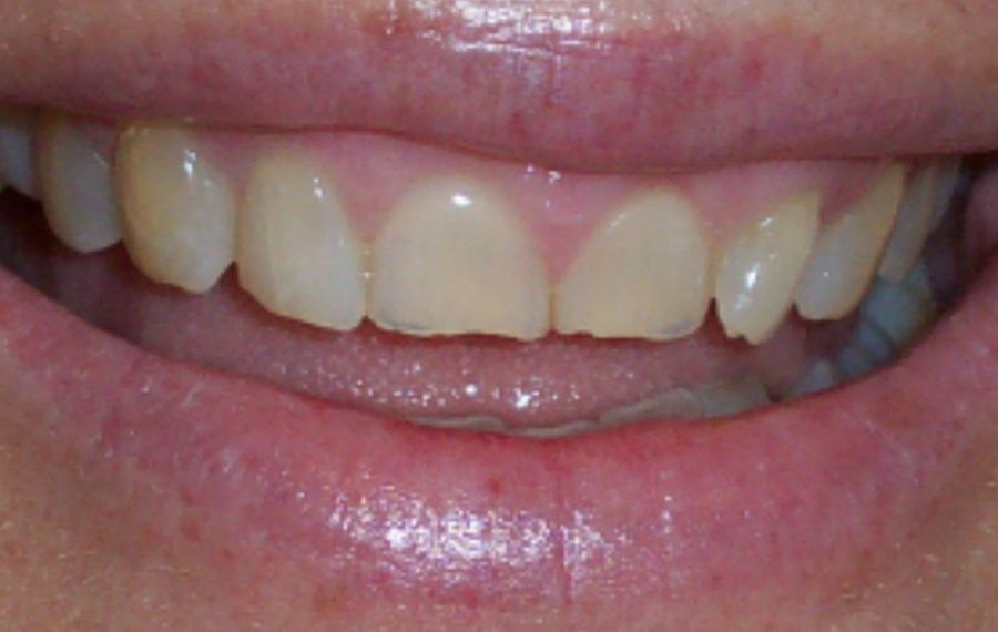 Zoom Teeth Whitening in Dubai