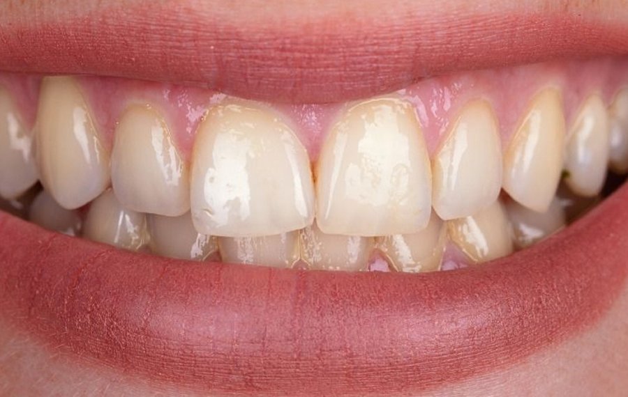 Zoom Teeth Whitening