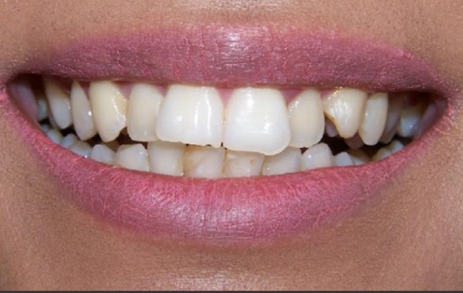 best Crowded Teeth Treatment