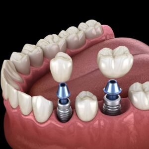 best age to get dental implants