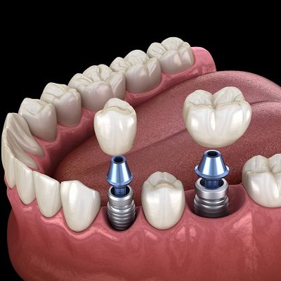 best age to get dental implants