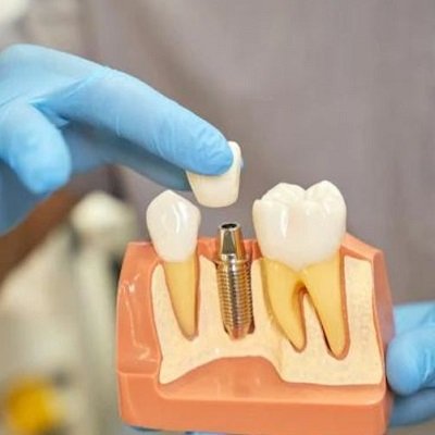 Facts about dental implant recovery process