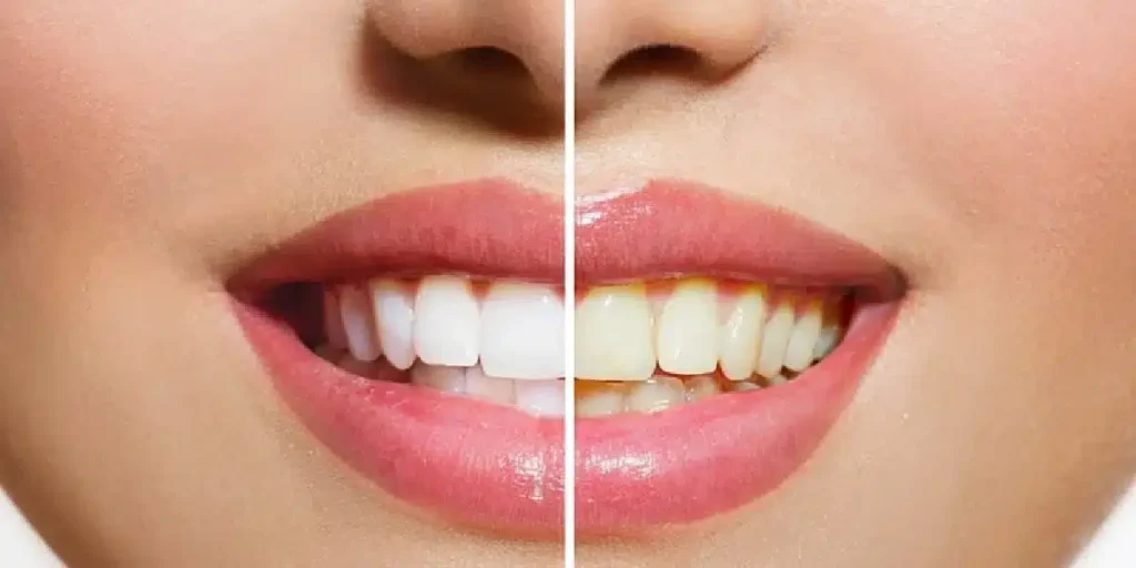 6 Natural Ways To Whiten Your Teeth