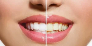 6 Natural Ways To Whiten Your Teeth
