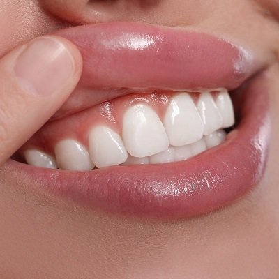 Best Gum Contouring Cost In Dubai - Enfield Dental Clinic