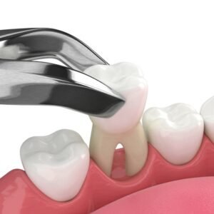 Best Tooth Removal Cost In Dubai - Teeth Removal Price