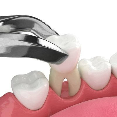 Best Tooth Removal Cost In Dubai - Teeth Removal Price
