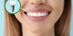 Dental Implant Healing Guide for a Smooth Recovery