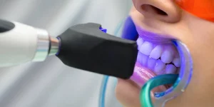 laser dental whitening
