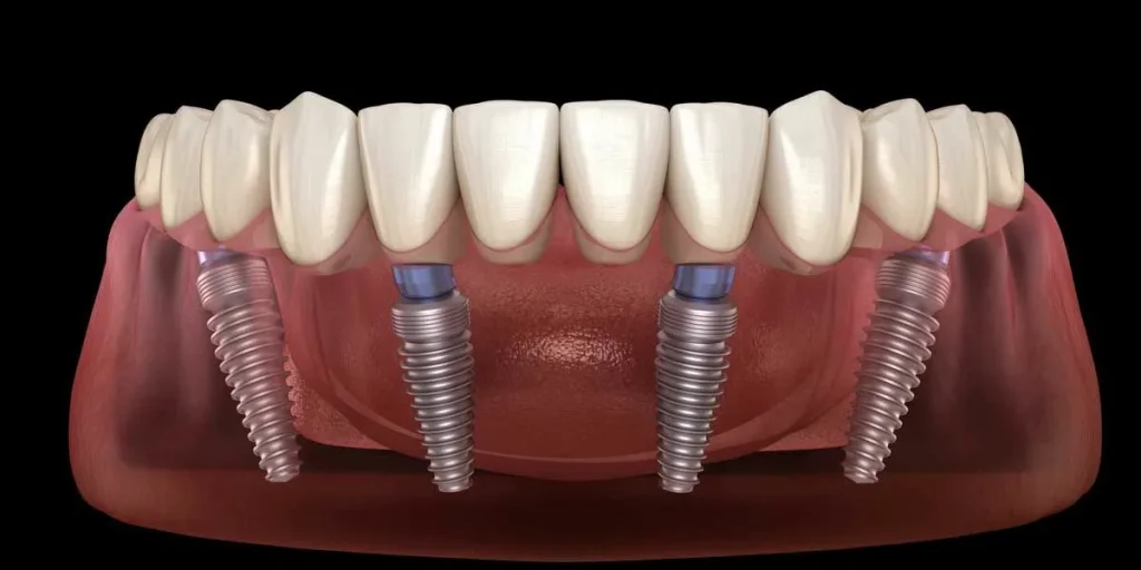 Dental Implants