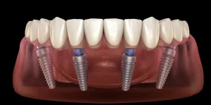 Dental Implants