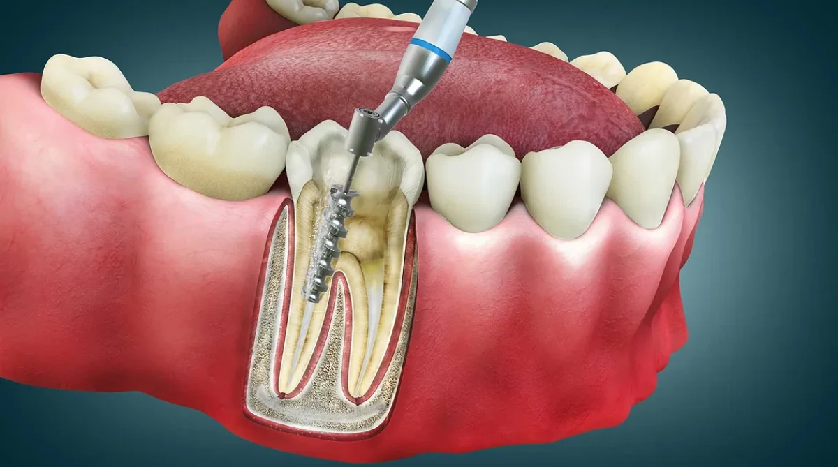 How Much Does Root Canal Treatment Cost in Dubai?