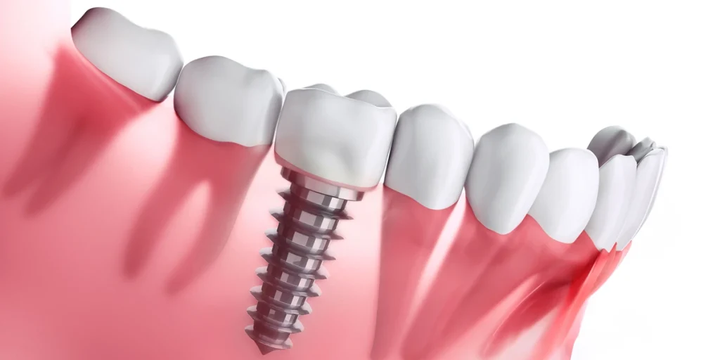 The Dental Implant Healing Time